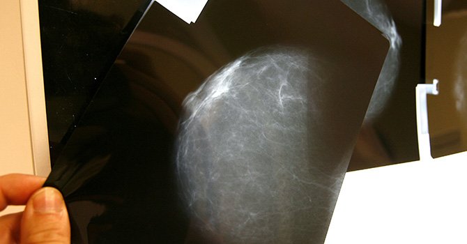 El efecto de la obesidad en los tejidos favorece el cáncer de mama