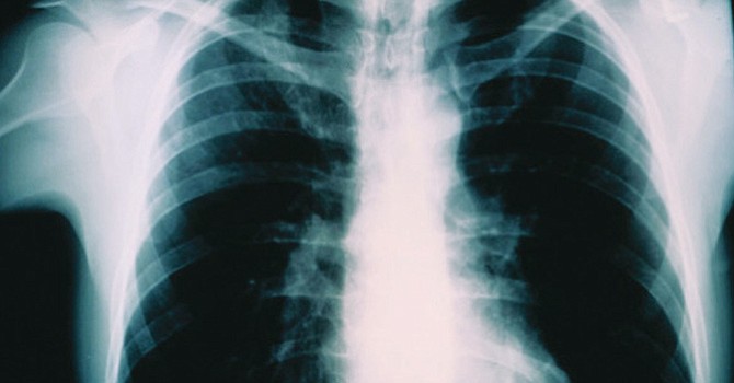 Dos nuevas posibles exposiciones a la Tuberculosis Activa en el Sur de San Diego