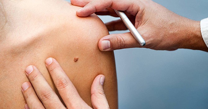 Tatuajes y camas de bronceado, muy malos para la salud; en promedio, cada hora muere por cáncer de piel una persona en los Estados Unidos