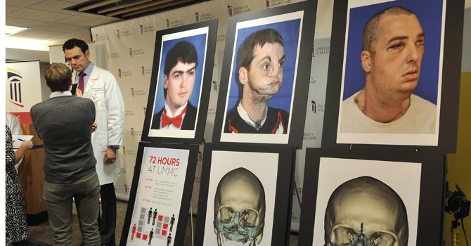 Virginia: paciente de trasplante de rostro sale a luz