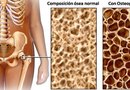 El 15 % de los mayores de 65 años sufre alguna caída en el año. Este accidente, que no suele ser grave en la juventud, puede tener serias consecuencias para los ancianos. PREVENCIÓN