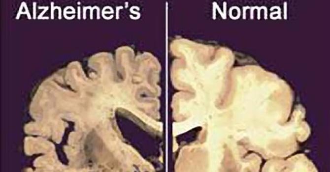 Desarrollan marcapasos cerebral contra el Alzheimer