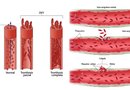 La mayoría de las personas no se dan cuenta que tienen coágulos en la pelvis. Así que la mejor manera de protegerse es llevando un estilo de vida saludable; hacer ejercicio de forma regular, perder el sobrepeso y no fumar.