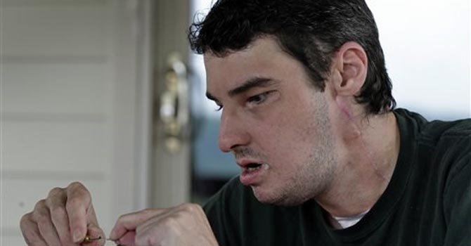 Con un trasplante de rostro, inicia nueva vida