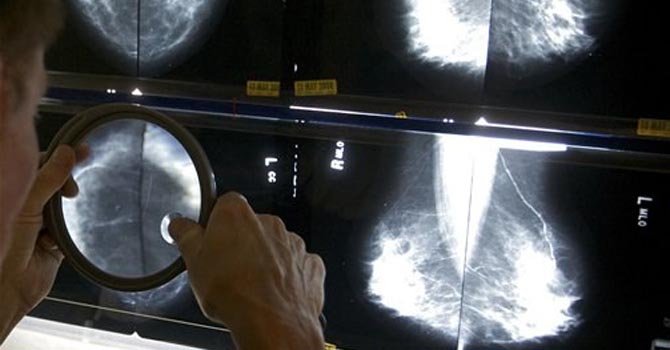 ¿Son necesarias las mamografías en tres dimensiones?