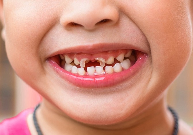 La investigación se basó exclusivamente en caries por su impacto en la salud infantil