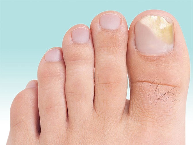 EN CASA. Para eliminar los hongos en las uñas de los pies puedes optar por remedios caseros o por los medicamentos que pueden ser aplicados sobre el hongo o mediante vía oral.