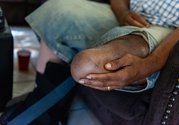 Jackson Moss tuvo que dejar de trabajar luego que sufrió la amputación de su pierna izquierda por debajo de la rodilla hace 10 años por una infección que contrajo en un dedo.
