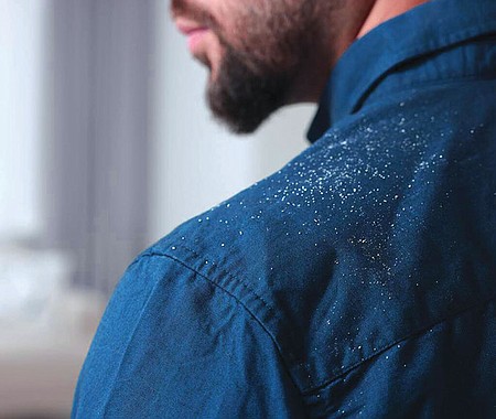 Existen diversos tratamientos para eliminar la caspa; sin embargo, la efectividad dependerá del tipo de cabello de la persona afectada y de cómo recibe los productos.