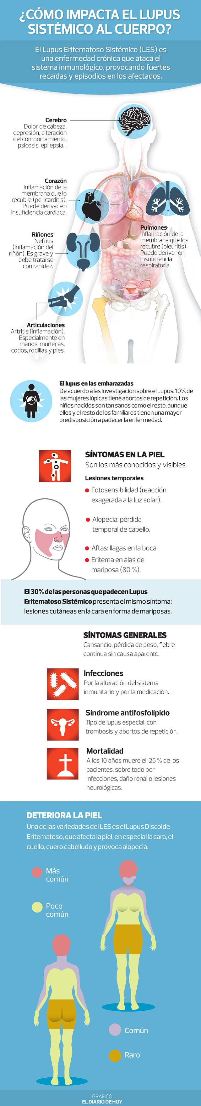 Lupus