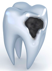 DAÑO. Si el diente no se limpia o protege, el esmalte con el tiempo se corroe, lo que resulta en la pérdida de la estructura dental.