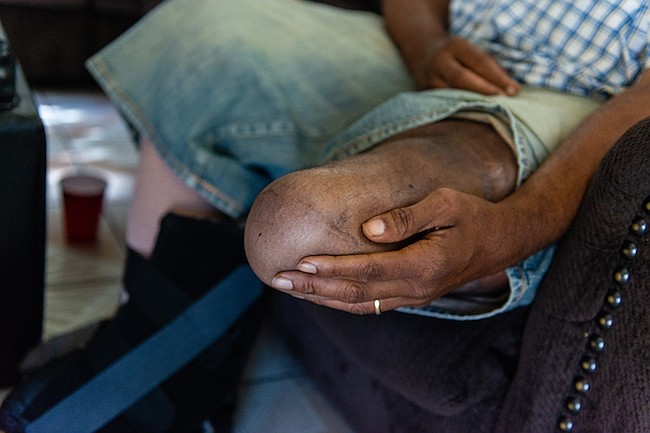 Jackson Moss tuvo que dejar de trabajar luego que sufrió la amputación de su pierna izquierda por debajo de la rodilla hace 10 años por una infección que contrajo en un dedo.